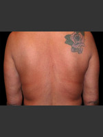 Before Photo Body Contouring Treatment #113 - Prejuvenation Before & After