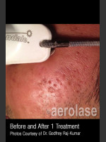 Before Photo #306 - Treatment of Acne Scars - Prejuvenation Before & After