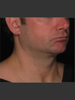 After Photo Treatment of Neck with Laser Liposuction - Prejuvenation Before & After