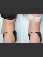 After Photo Liposuction of waist, hips, thighs, and tummy. - Prejuvenation Before & After