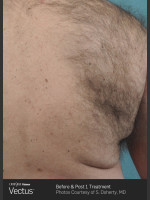 Before Photo Hair Removal of Back with Vectus - Prejuvenation Before & After