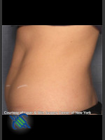 Before Photo CoolSculpting Treatment of Lower Abdomen Side On - Prejuvenation Before & After