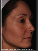 After Photo Treatment of Melasma - Prejuvenation Before & After