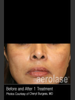 After Photo Treatment of Melasma #318 - Prejuvenation Before & After