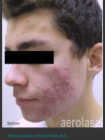 Before Photo NeoClear by Aerolase Acne Treatment - Prejuvenation Before & After
