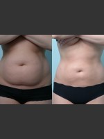 Before Photo Liposuction - Prejuvenation Before & After