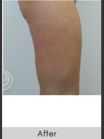 After Photo VanquishME with Cellutone Treatment - Prejuvenation Before & After