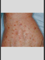 Before Photo Vbeam Laser Treatment of Pigmentation - Prejuvenation Before & After