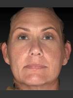 Before Photo Sun Damage Reduction - Prejuvenation Before & After