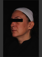 After Photo Treatment of Melasma - Prejuvenation Before & After