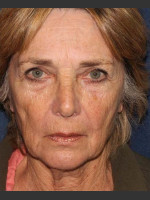Before Photo Facial Volumization - Prejuvenation Before & After