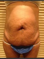 Before Photo Dr. Palmer Tummy Tuck 01  - Prejuvenation Before & After