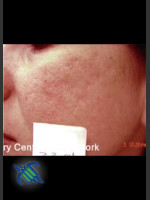 After Photo Treatment of Facial  Acne Scars Left Side - Prejuvenation Before & After