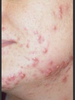 Before Photo Quanta Eterna IPL Acne Treatment #79 - Prejuvenation Before & After