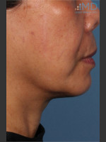 After Photo Ultherapy Skin Laxity Treatment of Lower Face - Prejuvenation Before & After