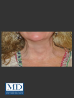 After Photo Neurotoxin of Neck 132 - Prejuvenation Before & After