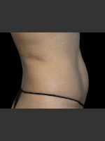 After Photo Body Contouring Treatment #118 - Prejuvenation Before & After
