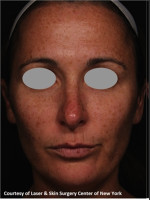 Before Photo Treatment of Facial Pigmentation - Prejuvenation Before & After