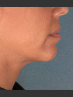 After Photo Kybella Treatment 34 Year Old Female - Prejuvenation Before & After