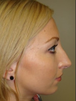 Before Photo Rhinoplasty 6574 - Prejuvenation Before & After