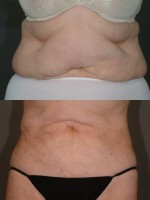 After Photo Liposuction - Prejuvenation Before & After