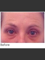 Before Photo Undereye Filler + Exilis Elite Radiofrequency - Prejuvenation Before & After