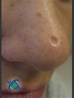 Before Photo Treatment of Nose Acne Scar - Prejuvenation Before & After