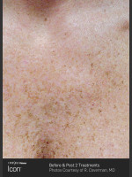 Before Photo Skin Revitalization of Chest Using Icon - Prejuvenation Before & After