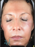 After Photo Treatment of Left Side Hyperpigmentation - Prejuvenation Before & After