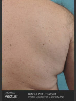 After Photo Hair Removal of Back with Vectus - Prejuvenation Before & After