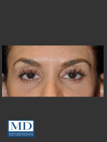 After Photo Midfacial Filler 136 - Prejuvenation Before & After