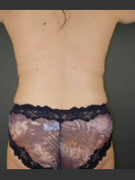 After Photo Liposuction #44 Back View - Prejuvenation Before & After