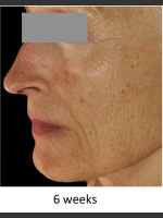 After Photo DefenAge Skincare Clinical Power Trio - Prejuvenation Before & After