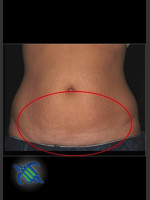 After Photo Treatment of Abdomen with CoolSculpting - Prejuvenation Before & After