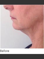 Before Photo Kybella and Filler for Jawline Definition  - Prejuvenation Before & After