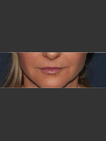 After Photo Lip Augmentation - Prejuvenation Before & After