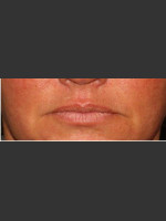 Before Photo Lip Plumping Treatment - Prejuvenation Before & After