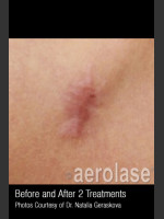 After Photo Treatment of Scars #346 - Prejuvenation Before & After