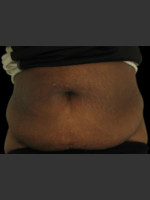 Before Photo Body Contouring Treatment #115 - Prejuvenation Before & After