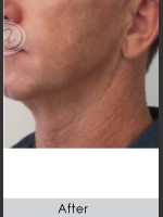 After Photo Male Jawline Enhancement with Radiesse - Prejuvenation Before & After
