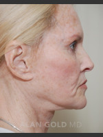 Before Photo Rhytidectomy (Facelift) 1753 Side View - Prejuvenation Before & After