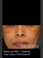 Before Photo Treatment of Melasma #318 - Prejuvenation Before & After