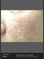 Before Photo Acne Scaring on the Cheeks - Prejuvenation Before & After