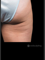 After Photo CoolSculpting Before & After on Woman - Prejuvenation Before & After