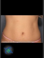 After Photo Treatment of Lower Abdomen with CoolSculpting - Prejuvenation Before & After