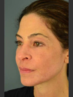After Photo C02 & Thermage Treatment #47 - Prejuvenation Before & After