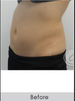 Before Photo CoolSculpting+ Abdomen Treatment - Prejuvenation Before & After