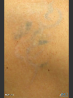 After Photo Picosure Laser Tattoo Removal of Lion - Prejuvenation Before & After