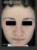 After Photo NeoClear by Aerolase Acne Treatment - Prejuvenation Before & After