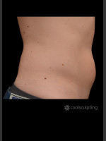 Before Photo CoolSculpting Before & After on Man - Prejuvenation Before & After